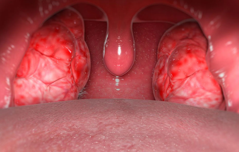 Tonsillectomy